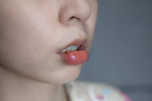 penyebab bibir bengkak alergi