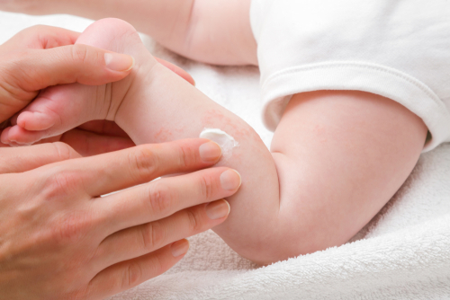 cara mengobati iritasi pada bayi          