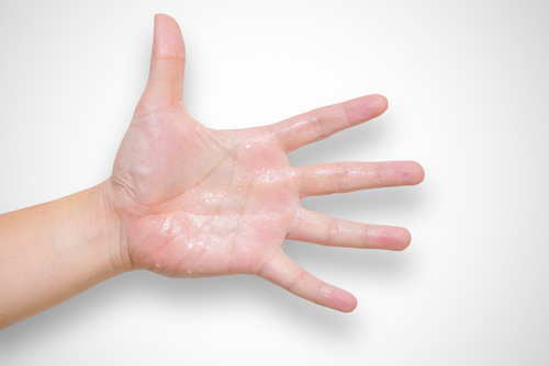 resiko dan cara mengatasi tangan berkeringat      