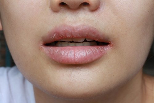 5 Cara Mengatasi Bibir Pecah-Pecah dan Penyebabnya