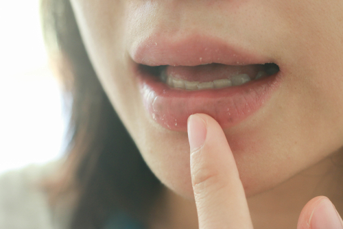 mengatasi bibir pecah-pecah dengan tidak menjilat bibir