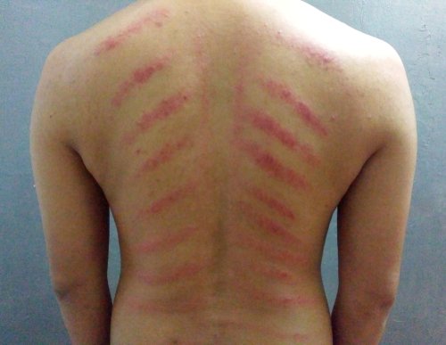 Manfaat dan Bahaya Kerokan