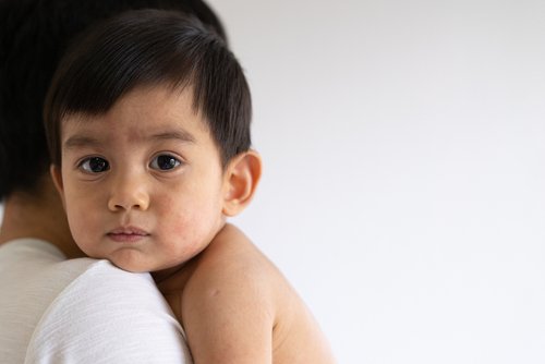 5 Jenis Penyakit Kulit Bayi yang Sering Menyerang