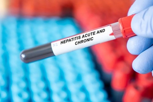 5 Tips Pencegahan Hepatitis Akut