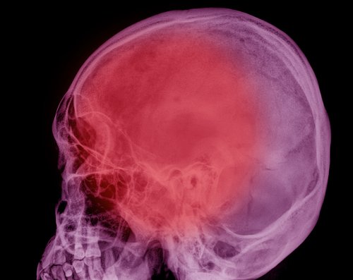 Empty Sella Syndrome, Berbahayakah?