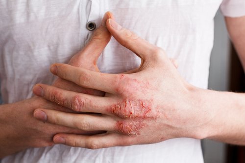 Mengenal Penyakit Psoriasis