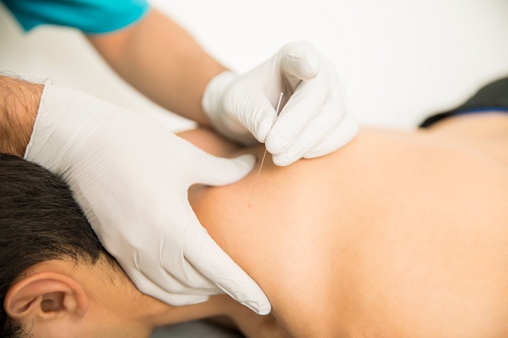 Dry Needling dengan Akupuntur, Apa Sih Bedanya?